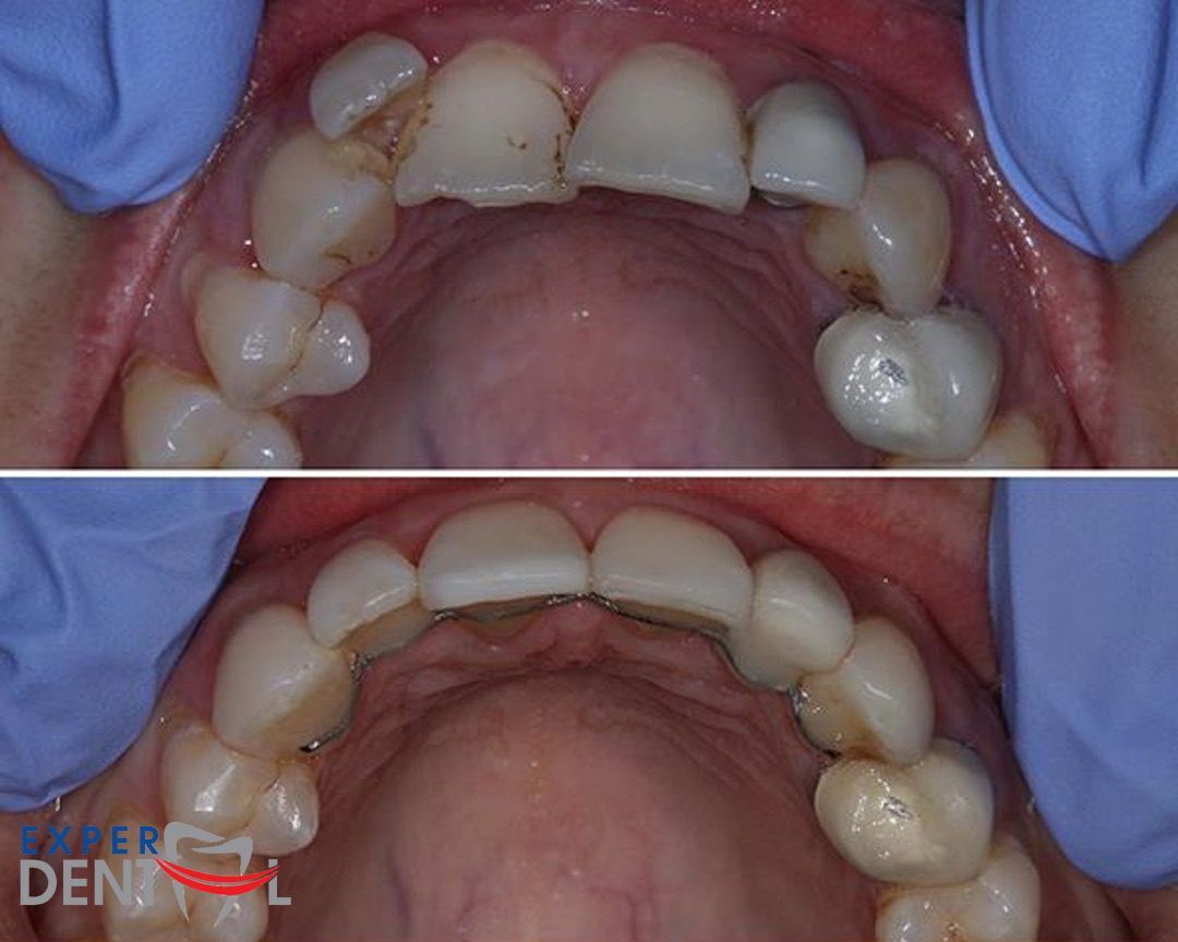 Teeth Straighetning 2