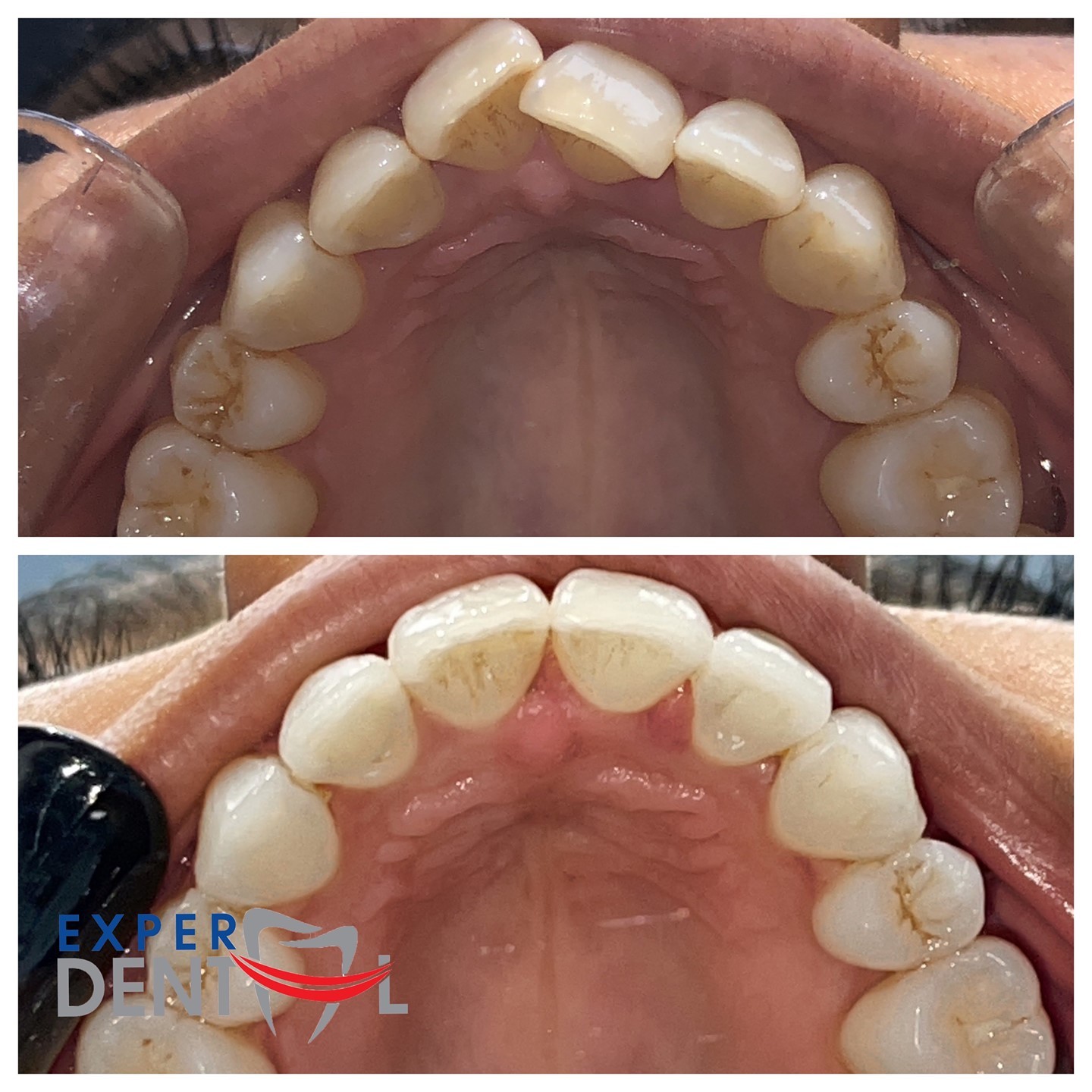 Teeth Straightening 4