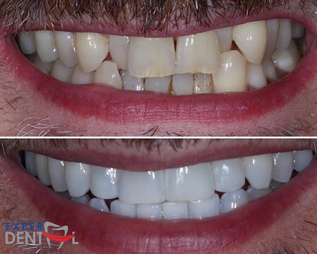 Teeth Straightening and Whitening 2
