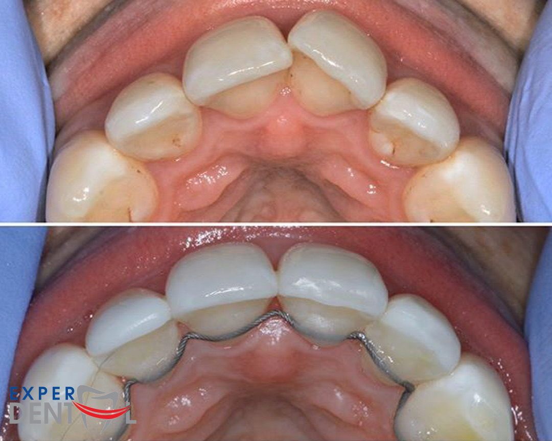 Teeth Straightening and Whitening